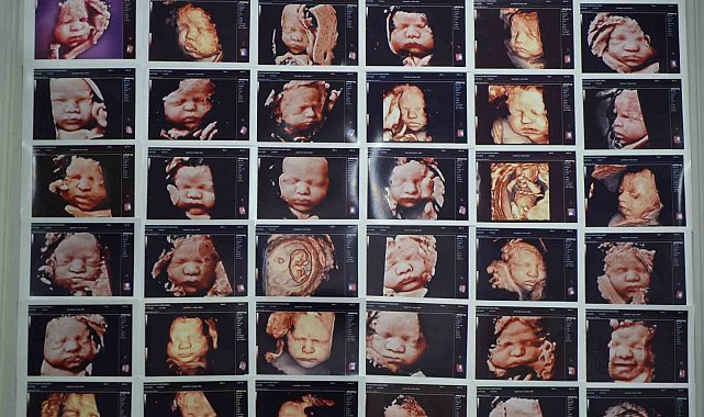 7 yıllık bebek hasreti "kişiye özel" tedaviyle son buldu