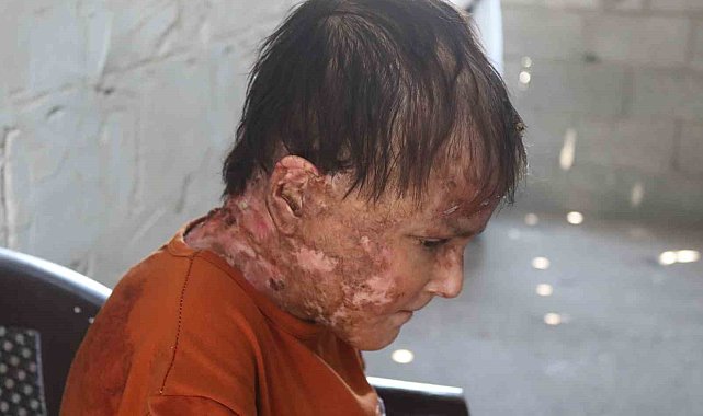 Gazze'de nadir cilt hastalığıyla mücadele eden genç kız: "İyileşip elbise giymenin hayalini kuruyorum"