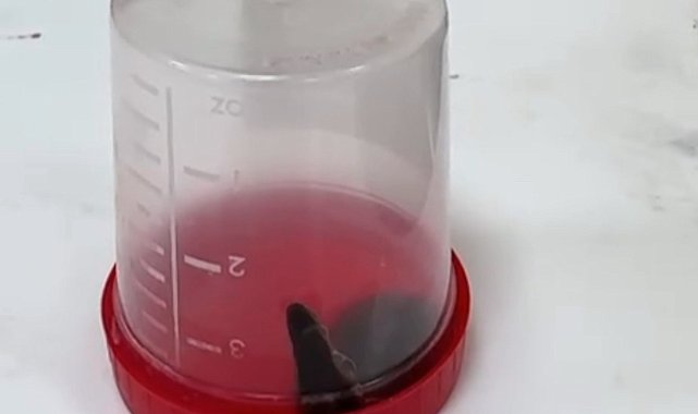 Siirt te 6 yaşındaki çocuğun boğazından sülük çıktı
