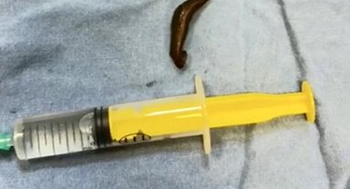 Şiddetli boğaz ağrısı şikayetiyle hastaneye gitti, sebebi şoke etti