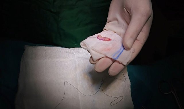 Ağız içinden alınan dokuyla idrar kanalındaki darlık tedavi edildi