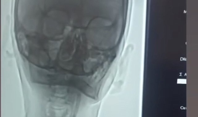 Iğdır'da şah damarı darlığına stentli müdahale