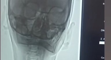 Iğdır'da şah damarı darlığına stentli müdahale