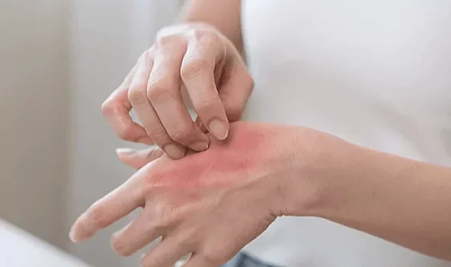 Kaşıntı yalnızca bir cilt sorunu olarak ele alınmamalı!