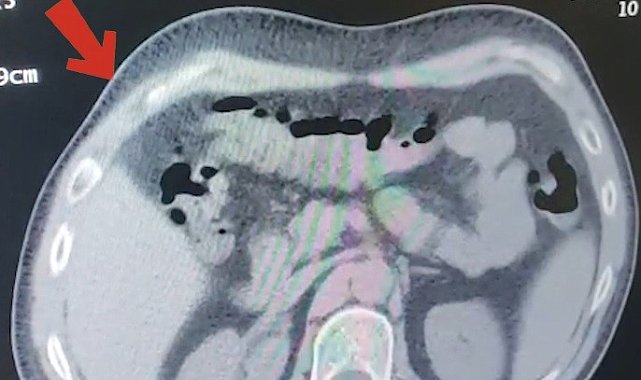 Mide ve bağırsaklarından 608 gram metamfetamin çıktı
