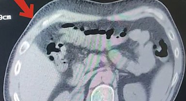 Mide ve bağırsaklarından 608 gram metamfetamin çıktı