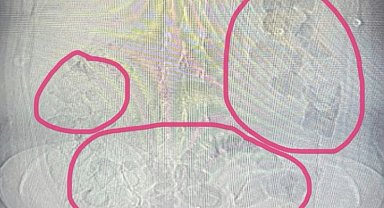 Midesinden uyuşturucu çıkan şahıs tutuklandı