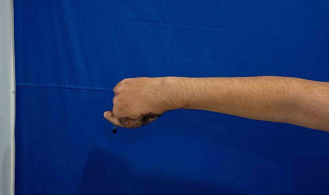 Parmaklarını kıyma makinesine kaptıran 13 yaşındaki çocuğa ayağından nakil